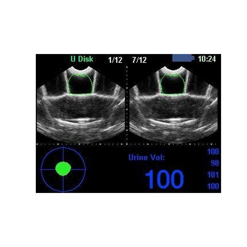 Kaixin BVT02 Bladder Scanner