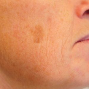 CryoIQ Derm Plus Cryotherapy Kit