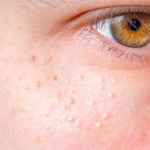 CryoIQ Derm Plus Cryotherapy Kit