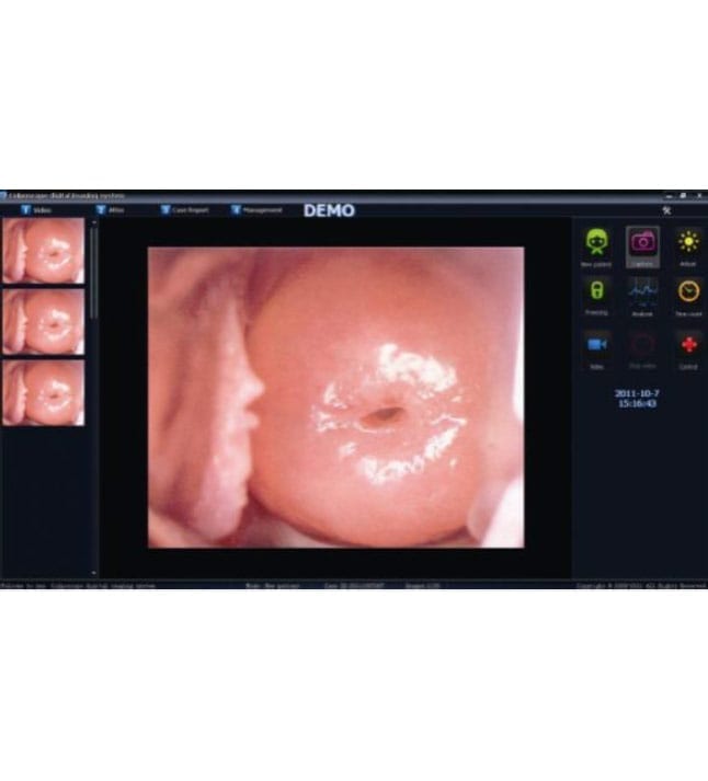 Alltion ACC Colposcopy Software HDMI Capture Card Professional Software