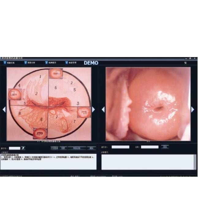 Alltion ACC Colposcopy Software HDMI Capture Card Professional Software