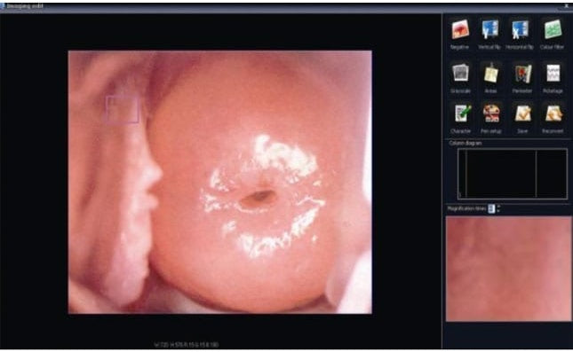 Alltion ACC Colposcopy Software HDMI Capture Card Professional Software