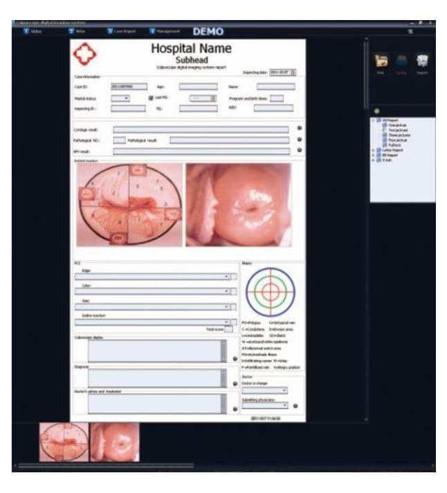 Alltion ACC Colposcopy Software HDMI Capture Card Professional Software