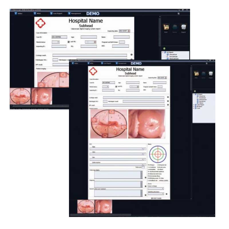 Alltion ACC Colposcopy Software HDMI Capture Card Professional Software
